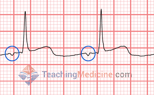 ecg-educator-blog-st-depression-t-wave-inversion-causes